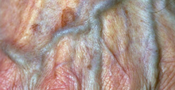 Жжение в области малых половых губ Жжение в области малых половых губ