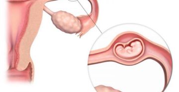 Планирование беременности с одной маточной трубой