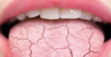 Трещины на языке