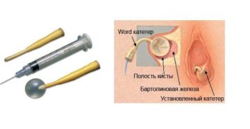 Удаление кисты борталиновой железы, word-катетер