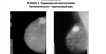 Уплотненный участок м/ж без четких контуров в верхнем-наружном квадранте