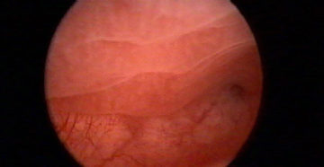 Эндометрий уменьшился Эндометрий уменьшился