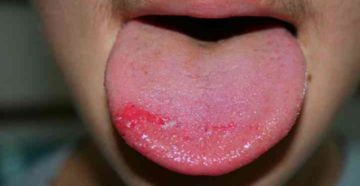 Лямблиоз, пятна на языке