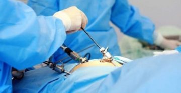 Отек паха после лапароскопии Отек паха после лапароскопии