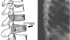 Перелом позвонка s5