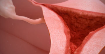 Во влагалище кусочки кожы