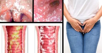 Молочница как побочка после Клиндацина