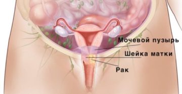 Уплотнение шейки матки
