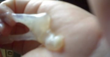 Жидкие выделения 34 недели Жидкие выделения 34 недели