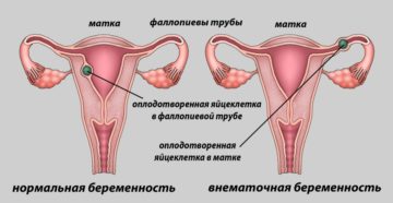 Возможны ли месячные при беременности
