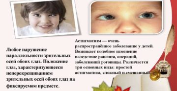 Косоглазие, астигматизм