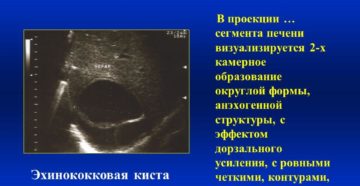 Округлое образование в s4 сегменте печени