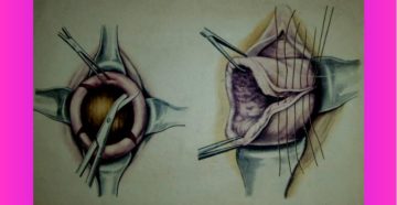 Снятие швов с шейки матки
