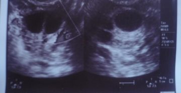 Отличие фолликула от кисты