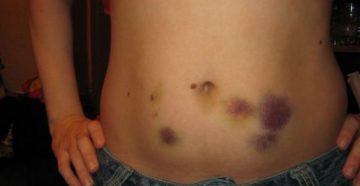 Образовался синяк на животе без внешних воздействий