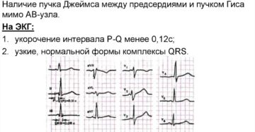 Укорочение интервала pq на экг