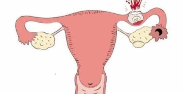 Планирование беременности с маточной перегородкой