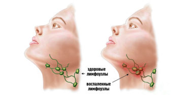 Подчелюстной лимфоузел
