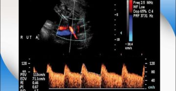 Нарушение кровотока в маточной артерии слева
