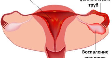 Воспаление яичников или нет