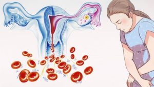 Длительная обильная менструация