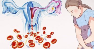 Длительная обильная менструация