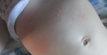 Аллергическая реакция на свечи Аллергическая реакция на свечи