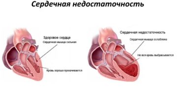 Сердечная недостаточность