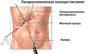 Боли после лапароскопии в правом боку