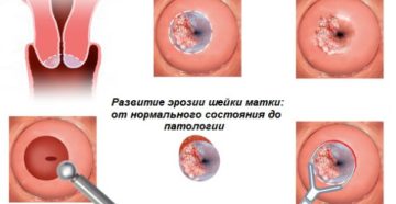 Кровянистые выделения после швов на шейке матки при беременности