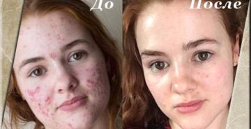 Беременность после роаккутана