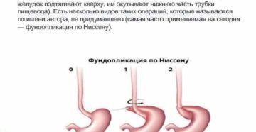 Операция при гэрб