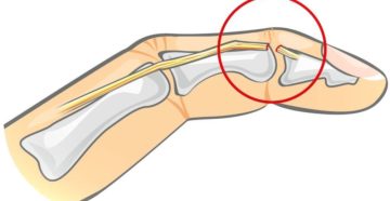 Закрытый отрыв сухожилия от ногтевой фаланги пальца