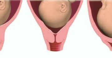 Короткая шейка на 27 неделе