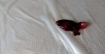 Боль и кровь через сутки после первого ПА