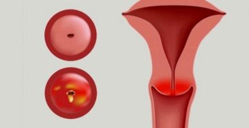 Хронический цервицит с уреаплазмой Хронический цервицит с уреаплазмой