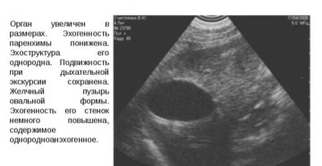 Стенки желчных протоков повышенной эхогенности
