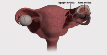 Киста яичника у девственниц