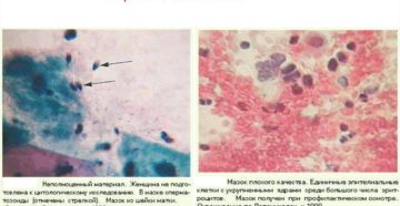 Воспалительный тип мазка на цитологию
