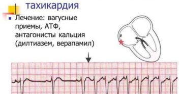 Тахикардия у подростка