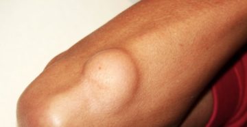 Твердая кишка