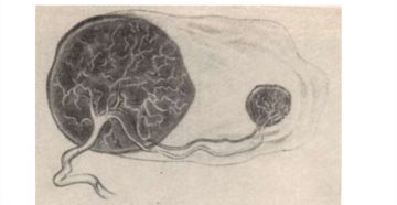 Добавочная доля плаценты, причины? Опасно ли?