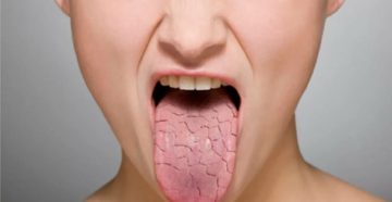 Сухость во рту и вздутие пострянное