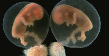 Двойня замер один плод