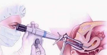 Нет менструации после гистероскопии