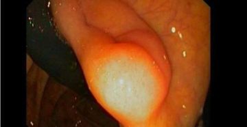 Колоноскопия, недостаточность Баугиниевой заслонки