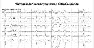 Пробежки наджелудочковой тахикардии