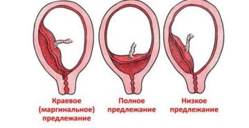 Краевое предлежание плаценты Краевое предлежание плаценты