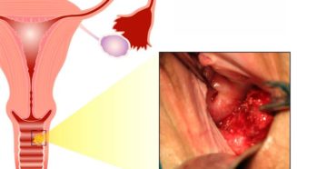 Жжение в районе уретры и влагалища