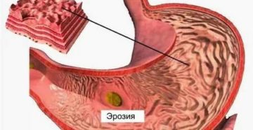 Эффективна ли замена кардимагнила на клопидогрель при эрозии желудка